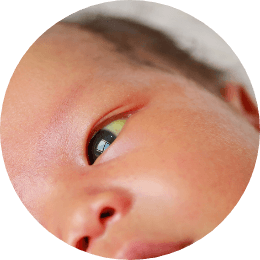 Face of a baby with jaundice